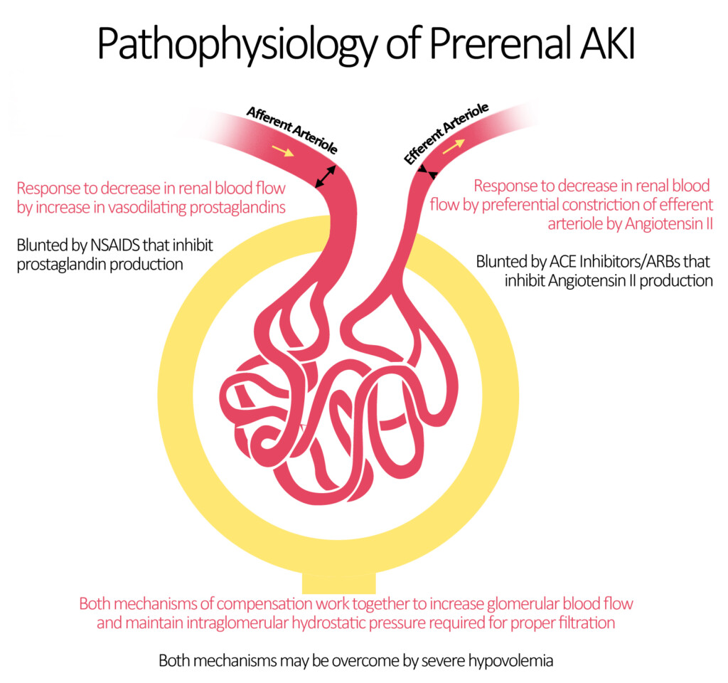 Acute Renal Failure Pathophysiology Wikidoc