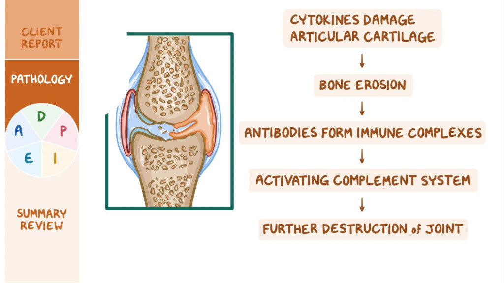 Artritis Reumatoide Rheumatoid Arthritis Inflammation NBKomputer