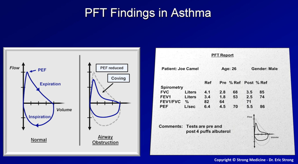 Asthma Treatment Flow Chart