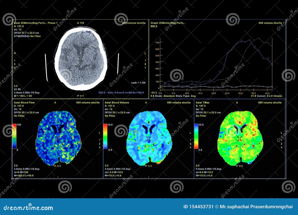 Brain Perfusion Or CT Scan Of Blood Flow In The Brain 3d Rendering 