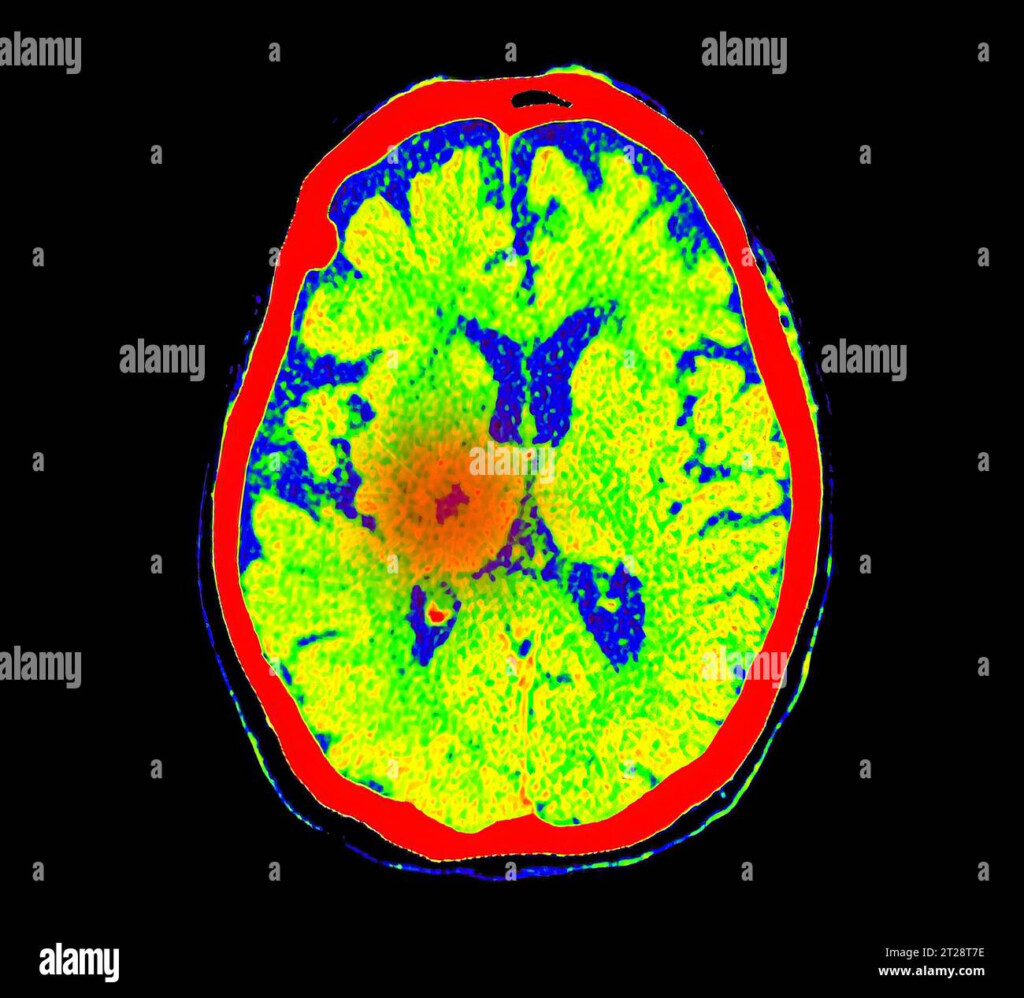 CT Brain Perfusion Or CT Scan Image Of The Brain Axial View Showing 