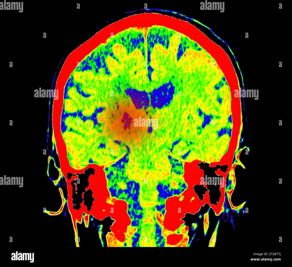 CT Brain Perfusion Or CT Scan Image Of The Brain Axial View Showing 