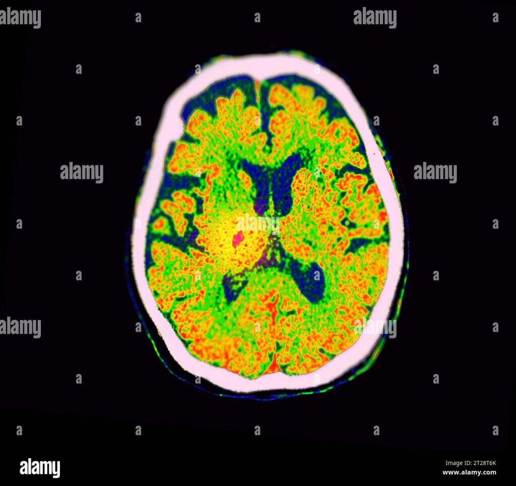 CT Brain Perfusion Or CT Scan Image Of The Brain Axial View Showing 