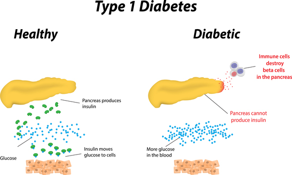 Diabetes Mellitus Type 1 Pathophysiology Wikidoc