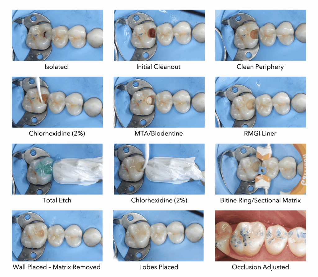 Indirect Pulp Capping Procedure Flow Chart Vrogue co