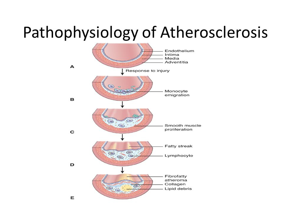 Pathogenesis Of Atherosclerosis Flow Chart Ponasa