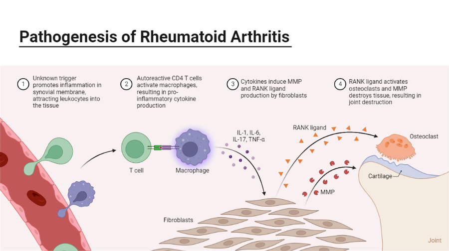 Pathogenesis Of Rheumatoid Arthritis BioRender Science Templates