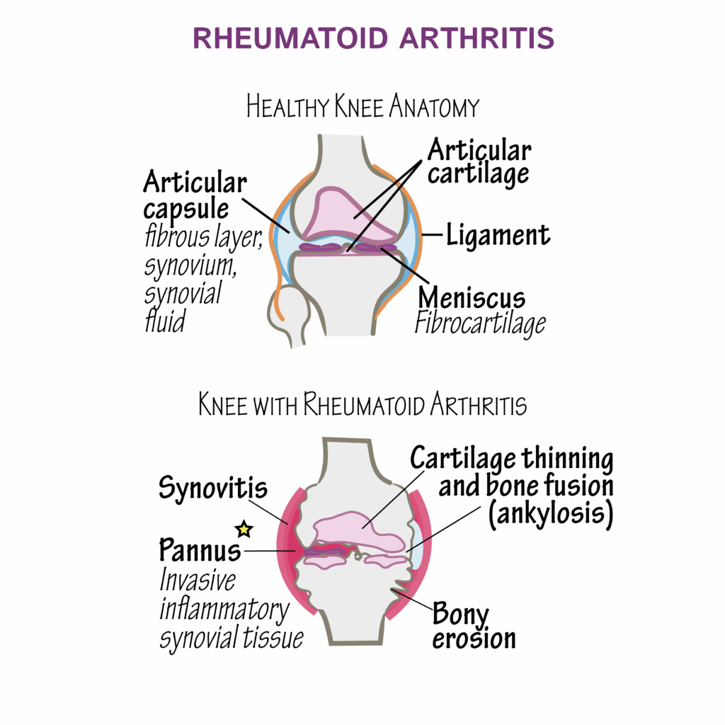 Pathology Glossary Rheumatoid Arthritis Draw It To Know It