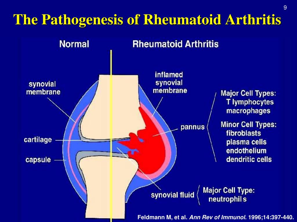 PPT Rheumatoid Arthritis PowerPoint Presentation Free Download ID 