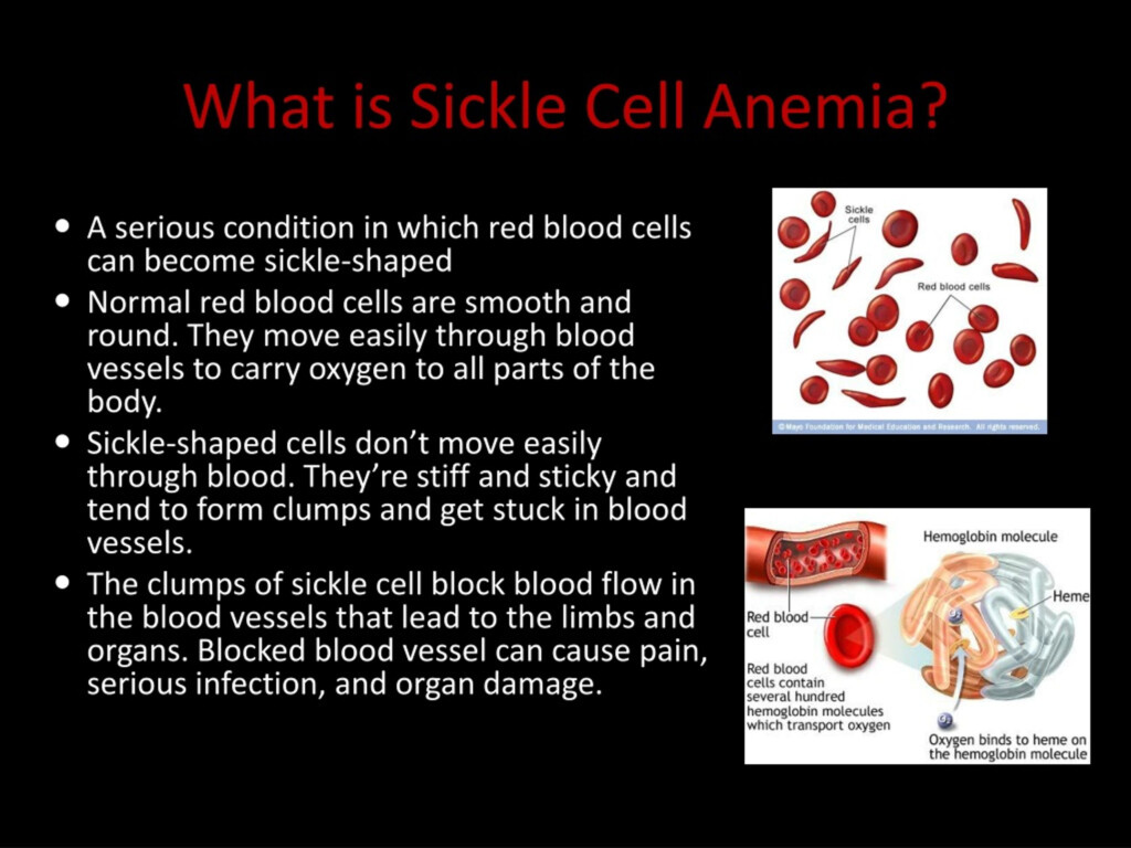PPT SICKLE CELL ANEMIA PowerPoint Presentation Free Download ID 393020