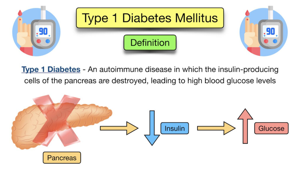 Schematic Diagram Of Type 1 Diabetes Mellitus Mellitus Pathophysiology 